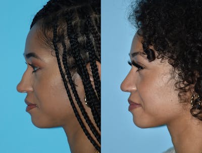 Rhinoplasty Before & After Gallery - Patient 180383015 - Image 1