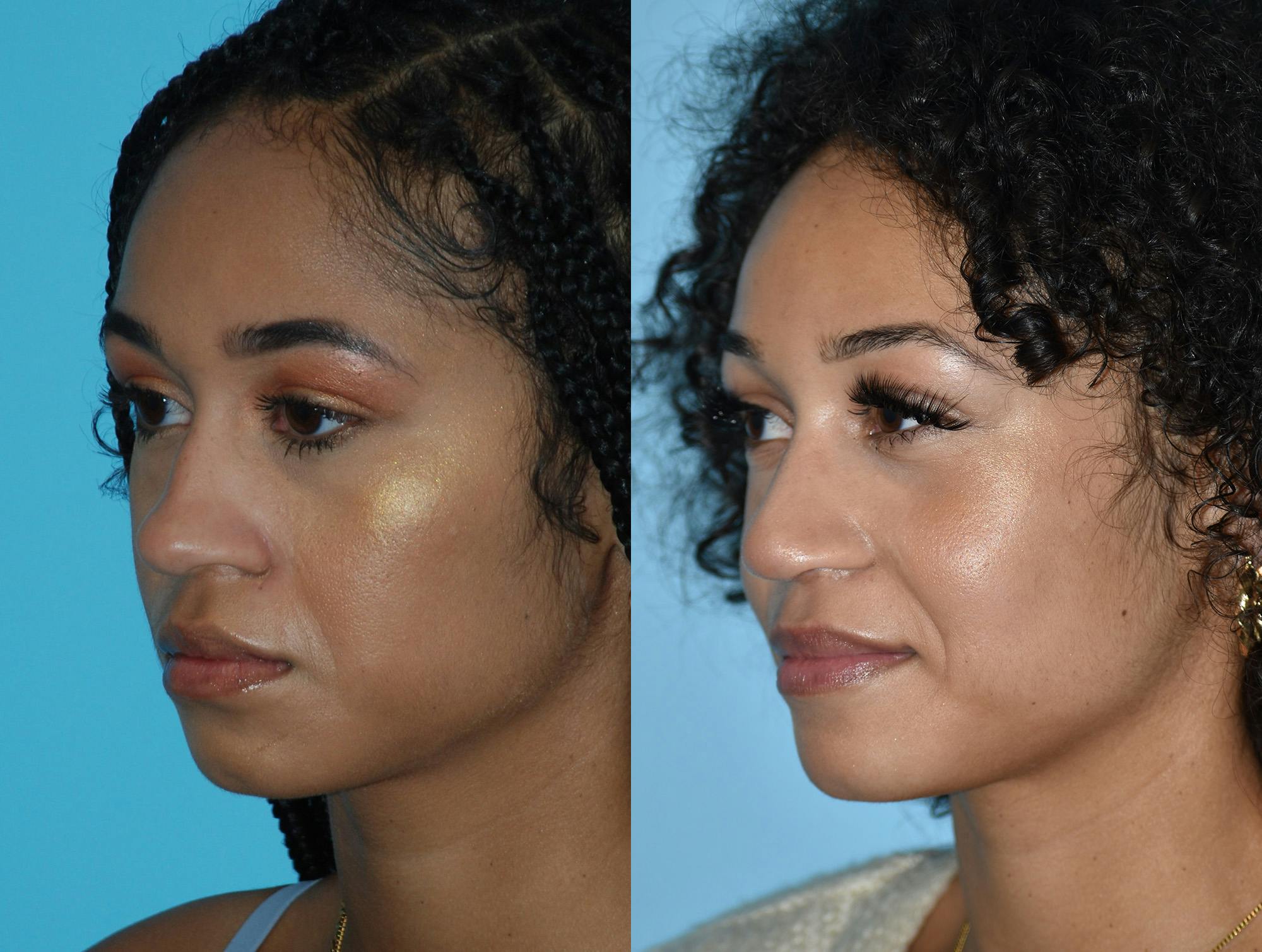 Rhinoplasty Before & After Gallery - Patient 180383015 - Image 2