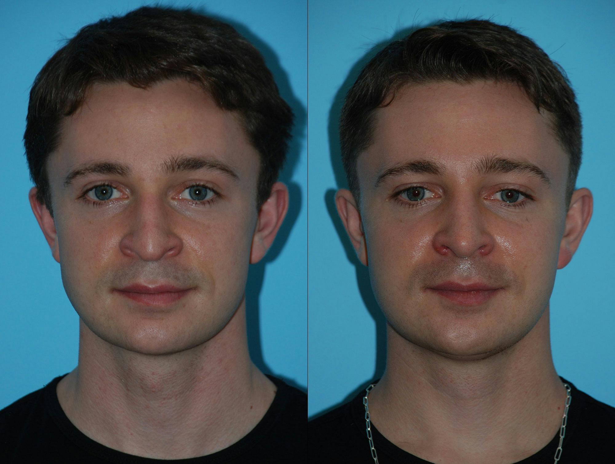 Rhinoplasty Before & After Gallery - Patient 180382925 - Image 3