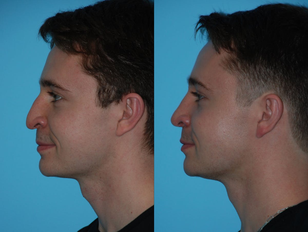 Rhinoplasty Before & After Gallery - Patient 180382925 - Image 1