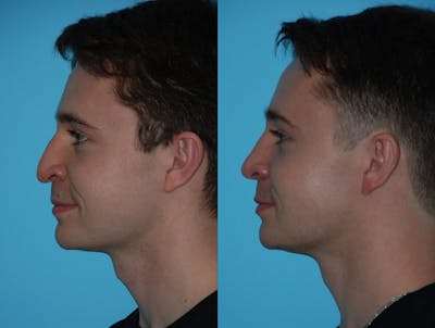 Rhinoplasty Before & After Gallery - Patient 180382925 - Image 1