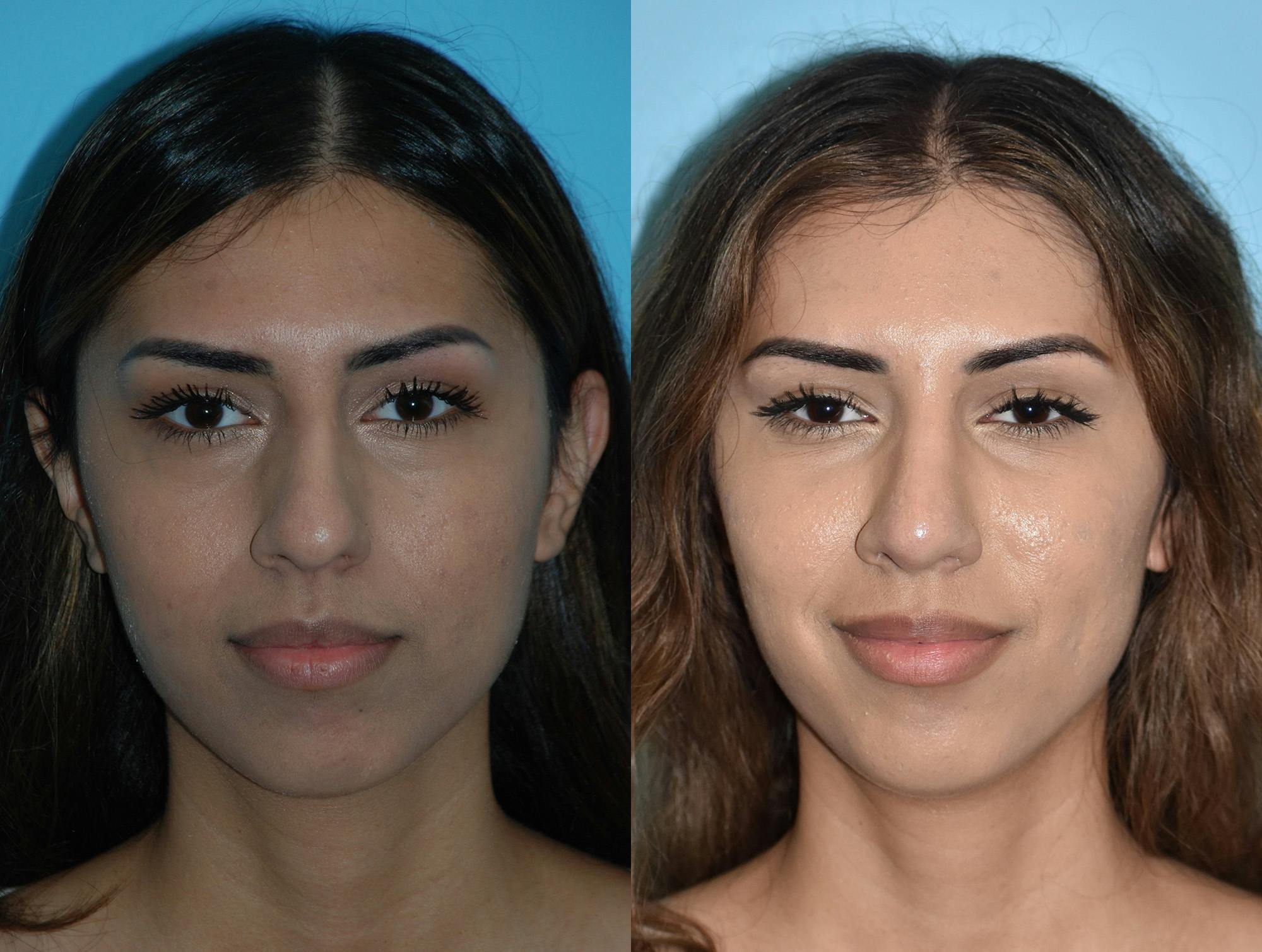 Rhinoplasty Before & After Gallery - Patient 180383018 - Image 3