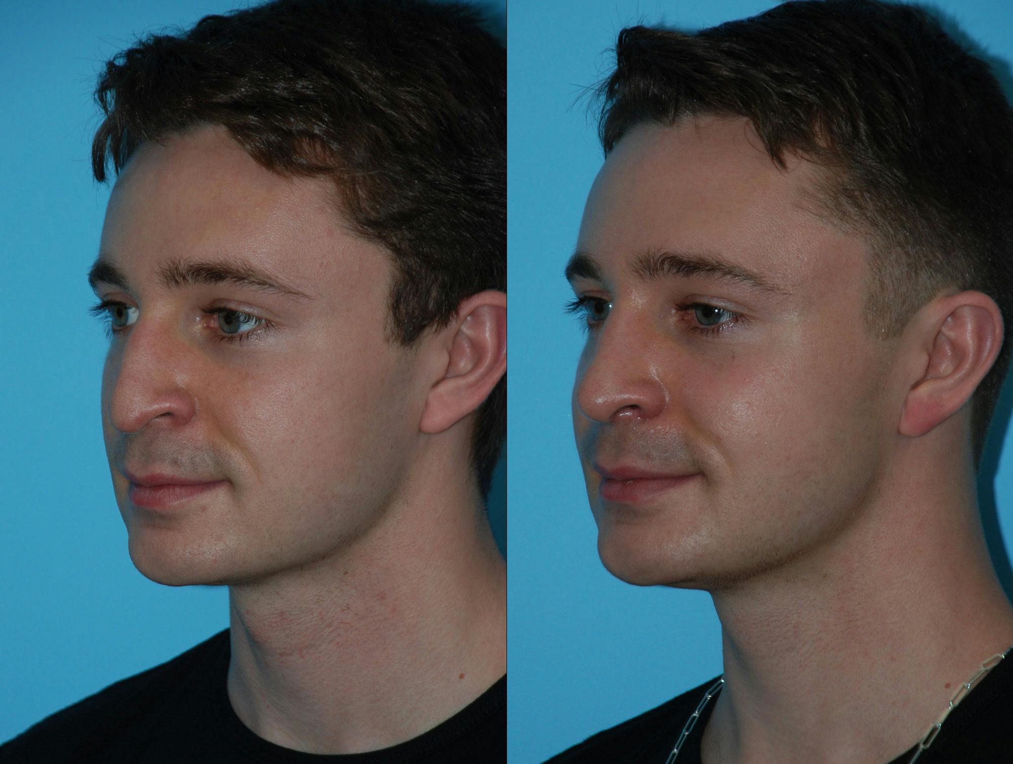 Rhinoplasty Before & After Gallery - Patient 180382925 - Image 2