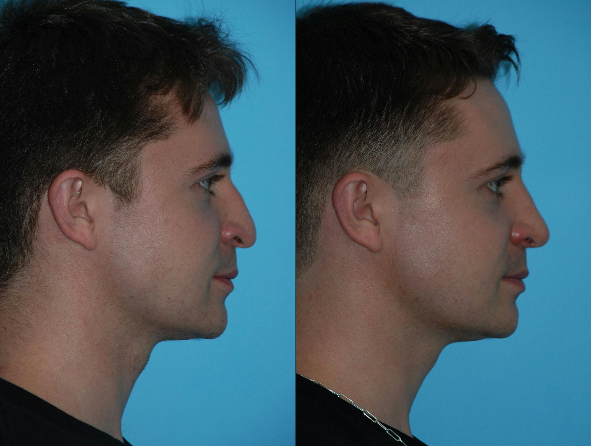 Rhinoplasty Before & After Gallery - Patient 180382925 - Image 5