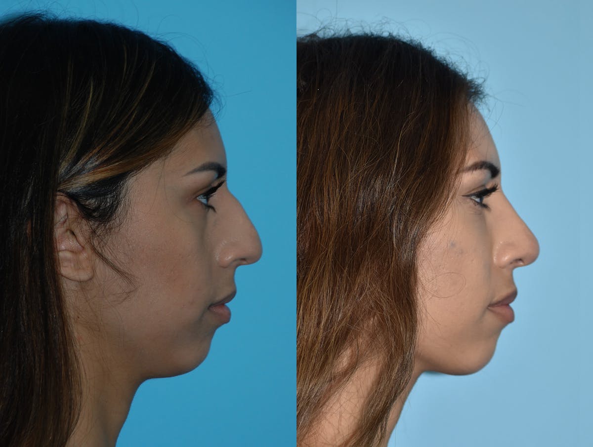Rhinoplasty Before & After Gallery - Patient 180383018 - Image 5