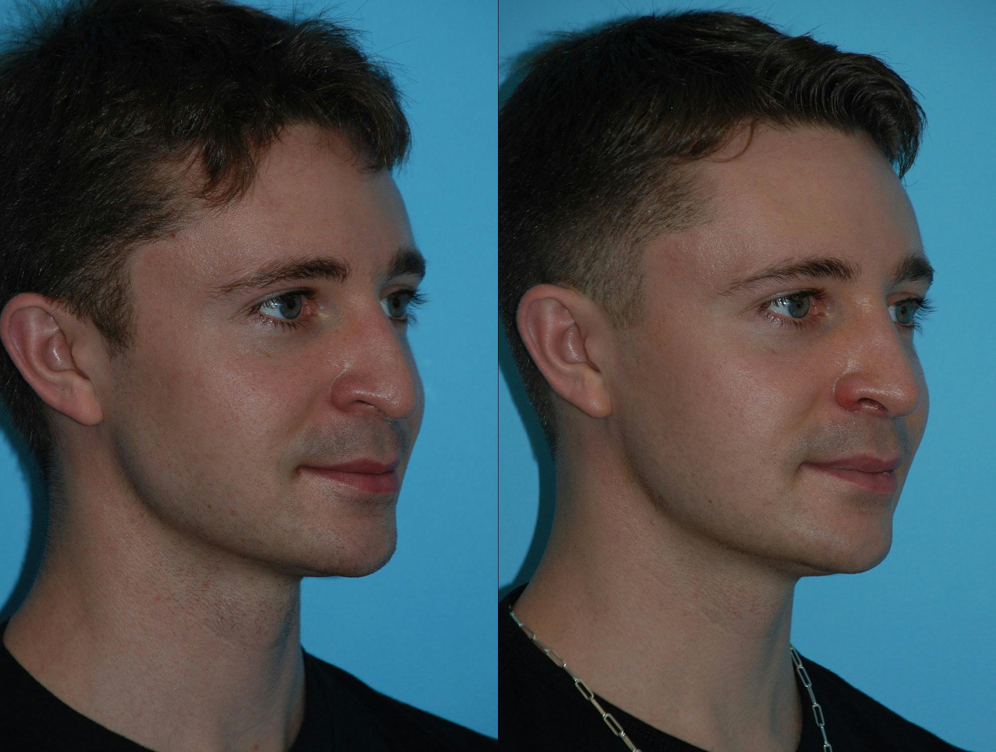 Rhinoplasty Before & After Gallery - Patient 180382925 - Image 4