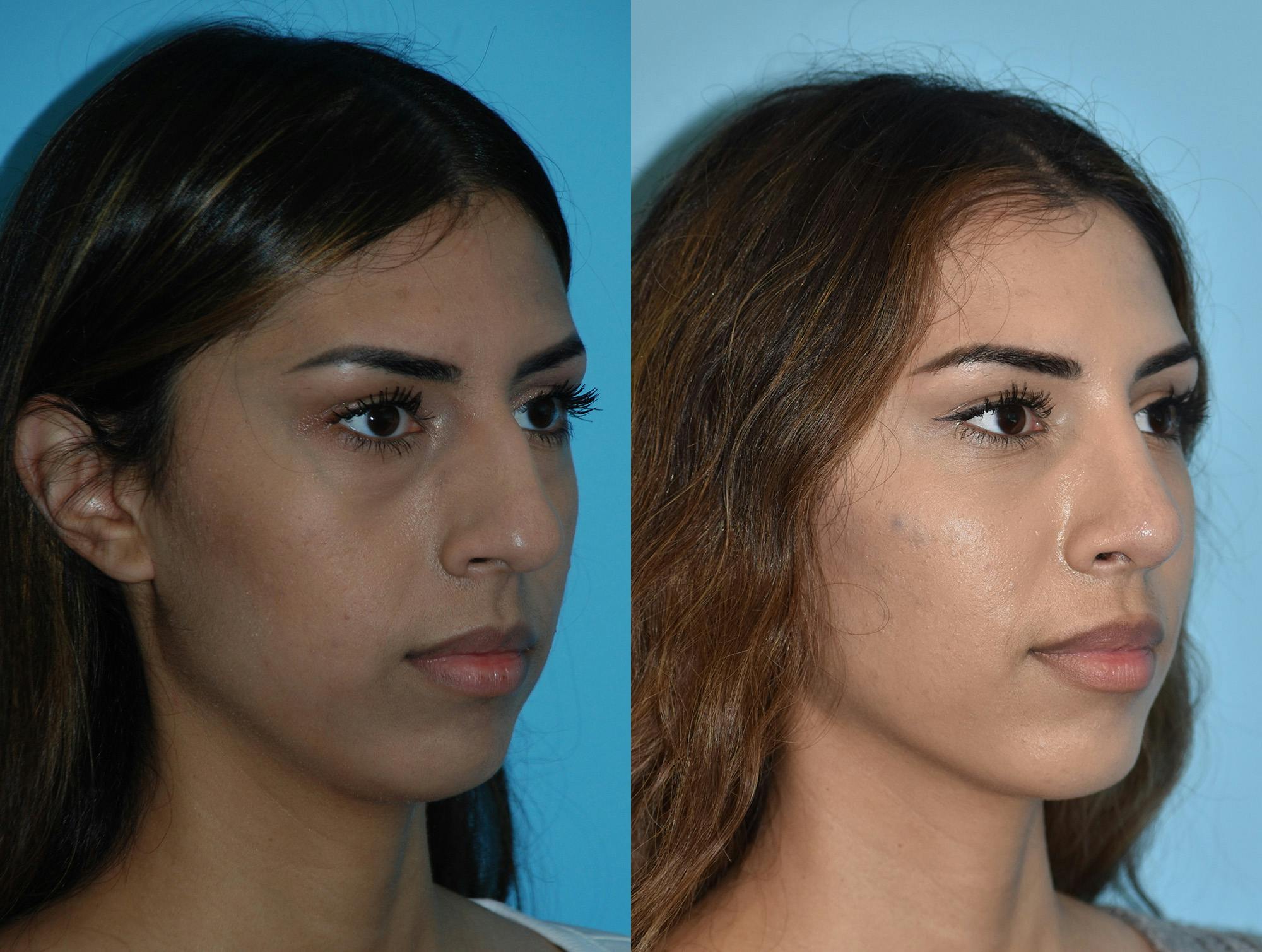 Rhinoplasty Before & After Gallery - Patient 180383018 - Image 4