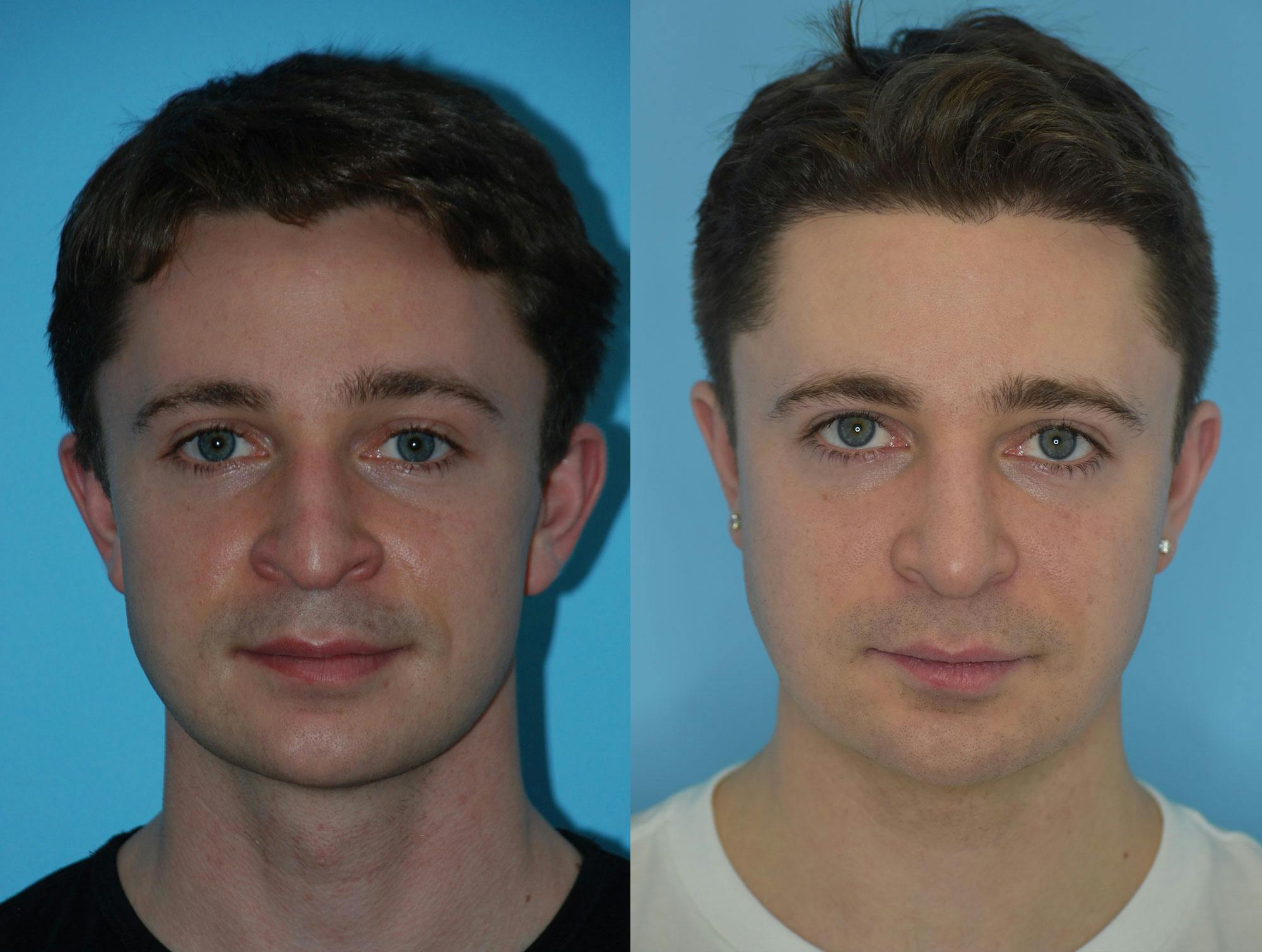 Rhinoplasty Before & After Gallery - Patient 180382925 - Image 6