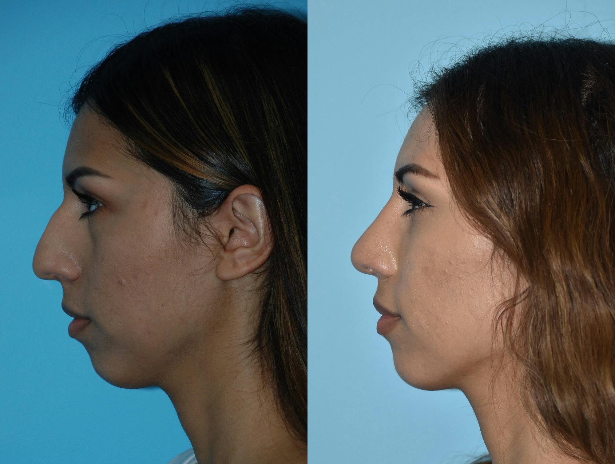 Rhinoplasty Before & After Gallery - Patient 180383018 - Image 1