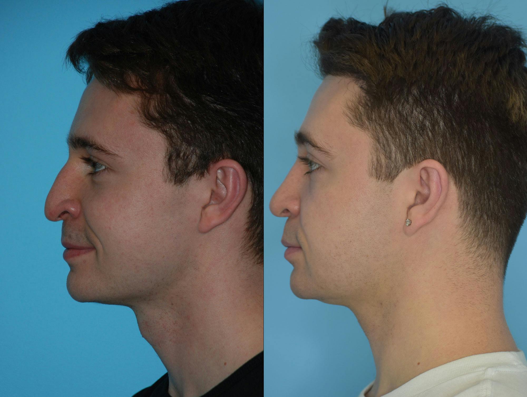 Rhinoplasty Before & After Gallery - Patient 180382925 - Image 10