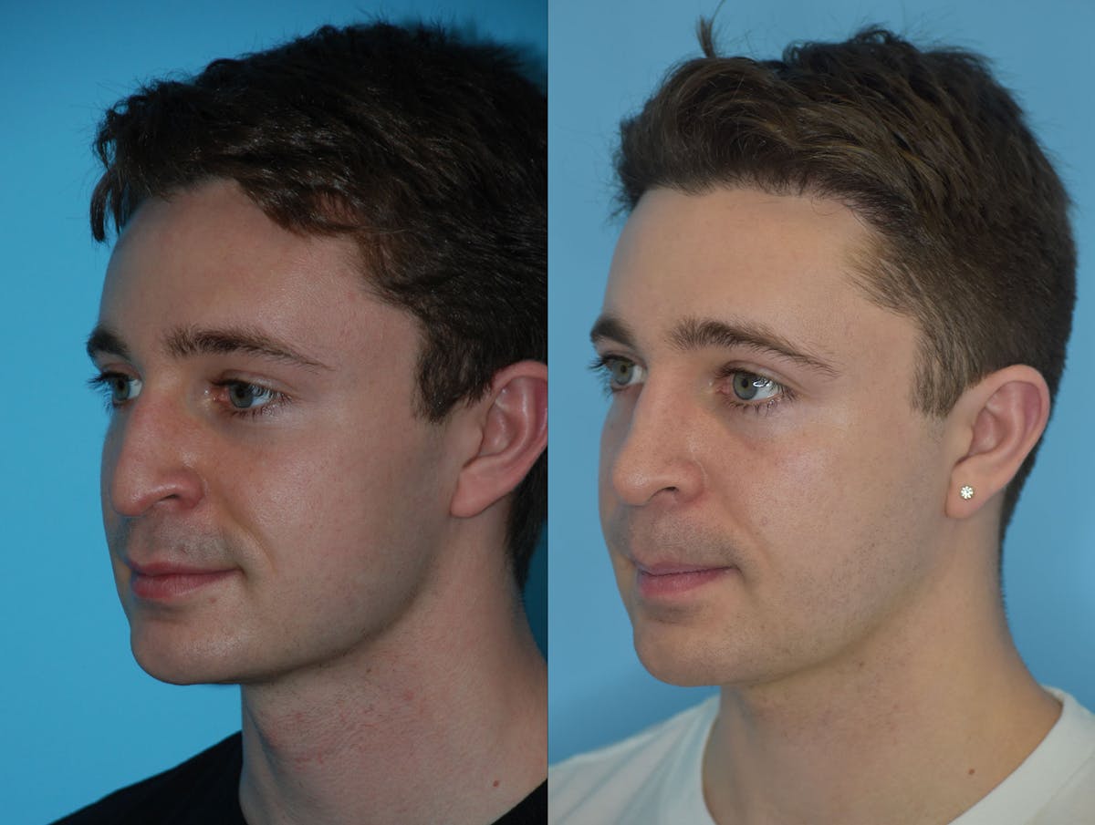 Rhinoplasty Before & After Gallery - Patient 180382925 - Image 9