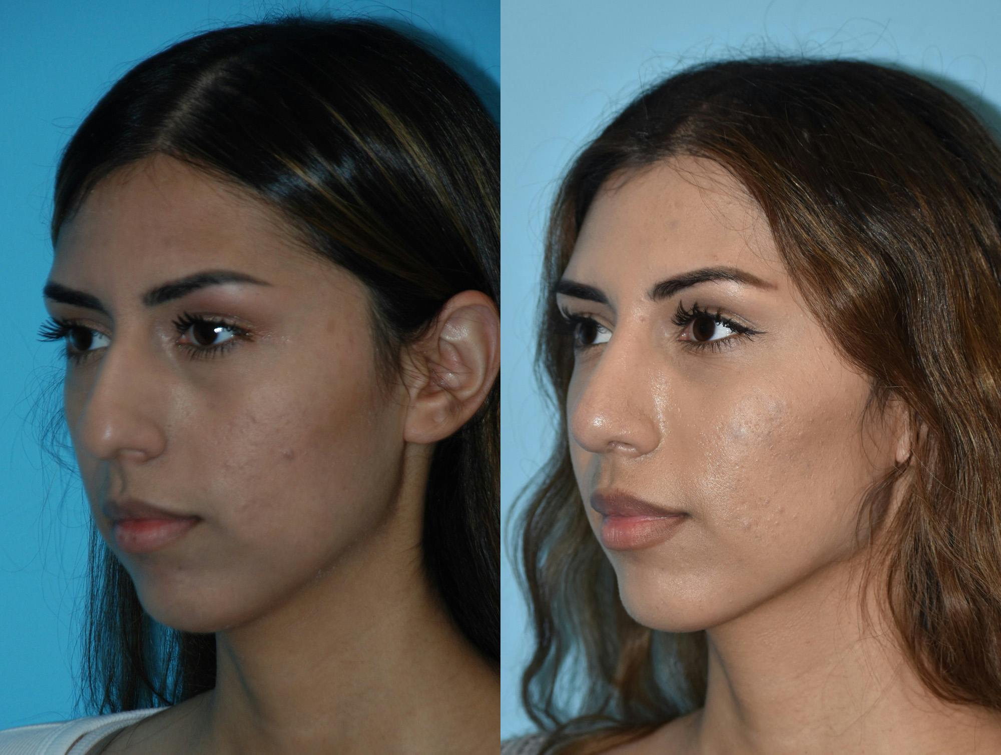 Rhinoplasty Before & After Gallery - Patient 180383018 - Image 2