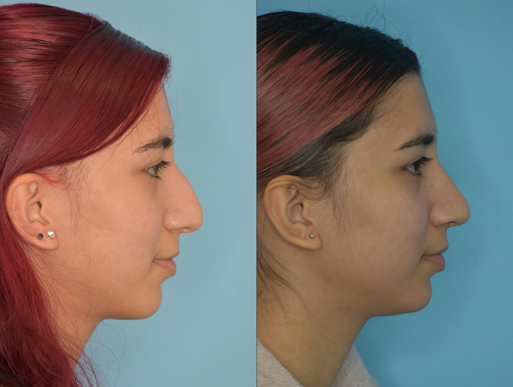 Rhinoplasty Before & After Gallery - Patient 180383014 - Image 4