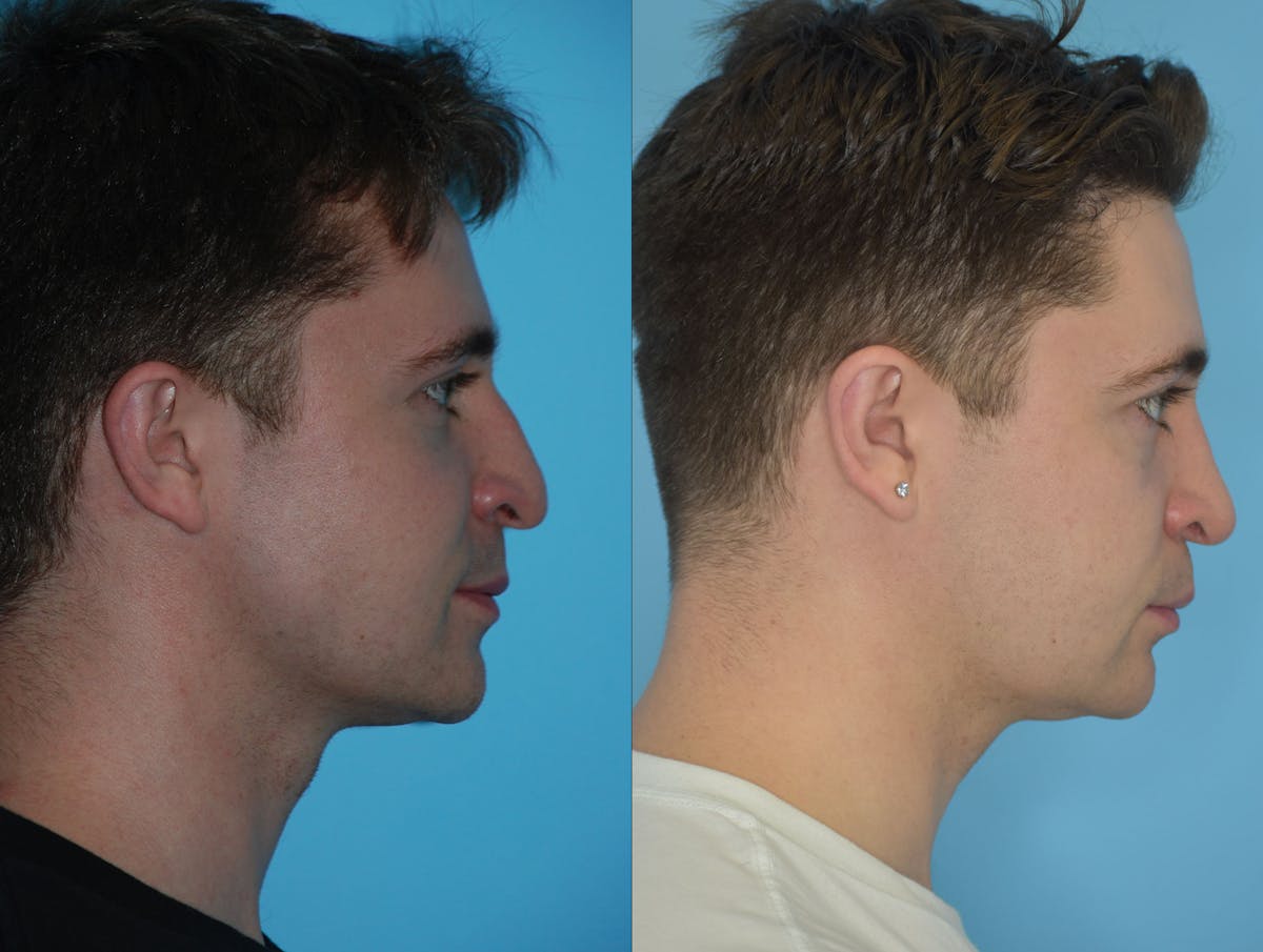 Rhinoplasty Before & After Gallery - Patient 180382925 - Image 8