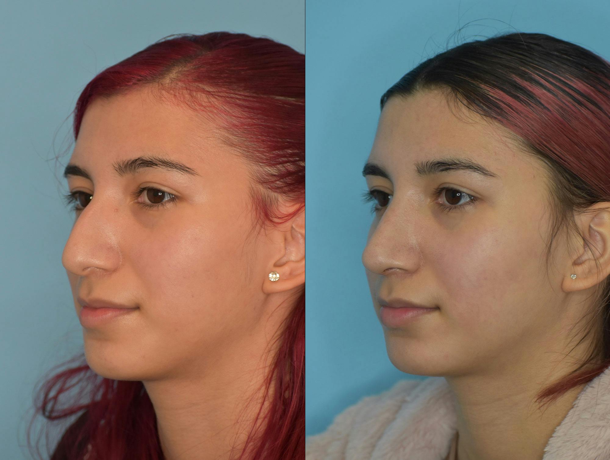 Rhinoplasty Before & After Gallery - Patient 180383014 - Image 2