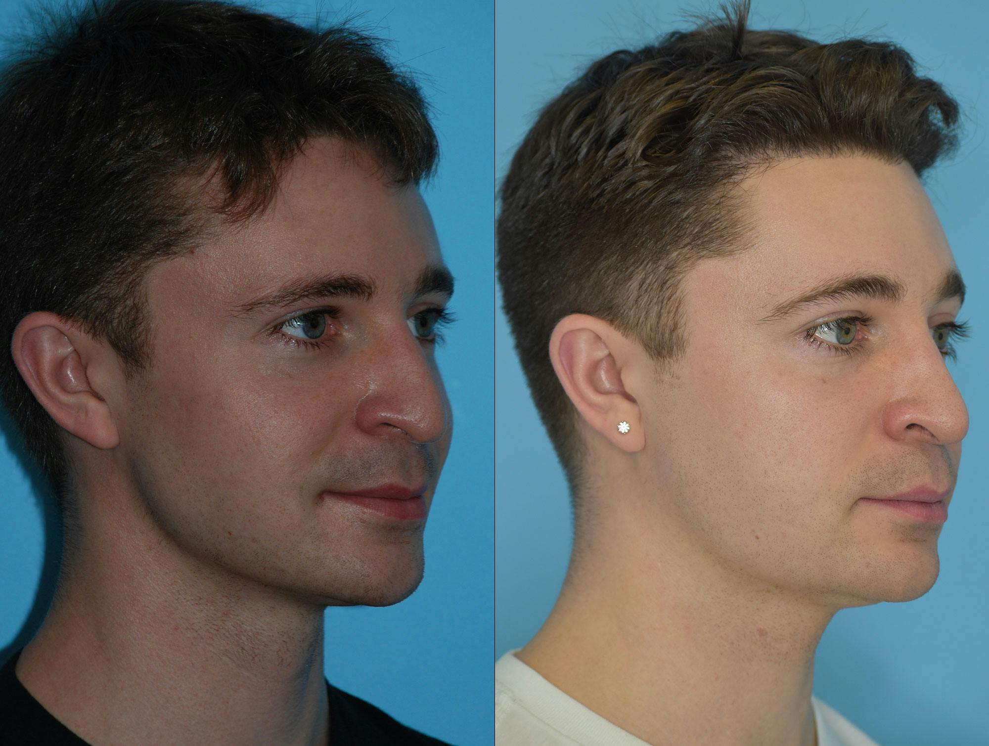 Rhinoplasty Before & After Gallery - Patient 180382925 - Image 7
