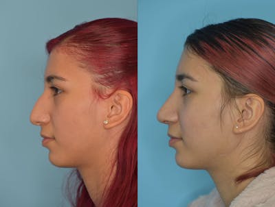 Rhinoplasty Before & After Gallery - Patient 180383014 - Image 1