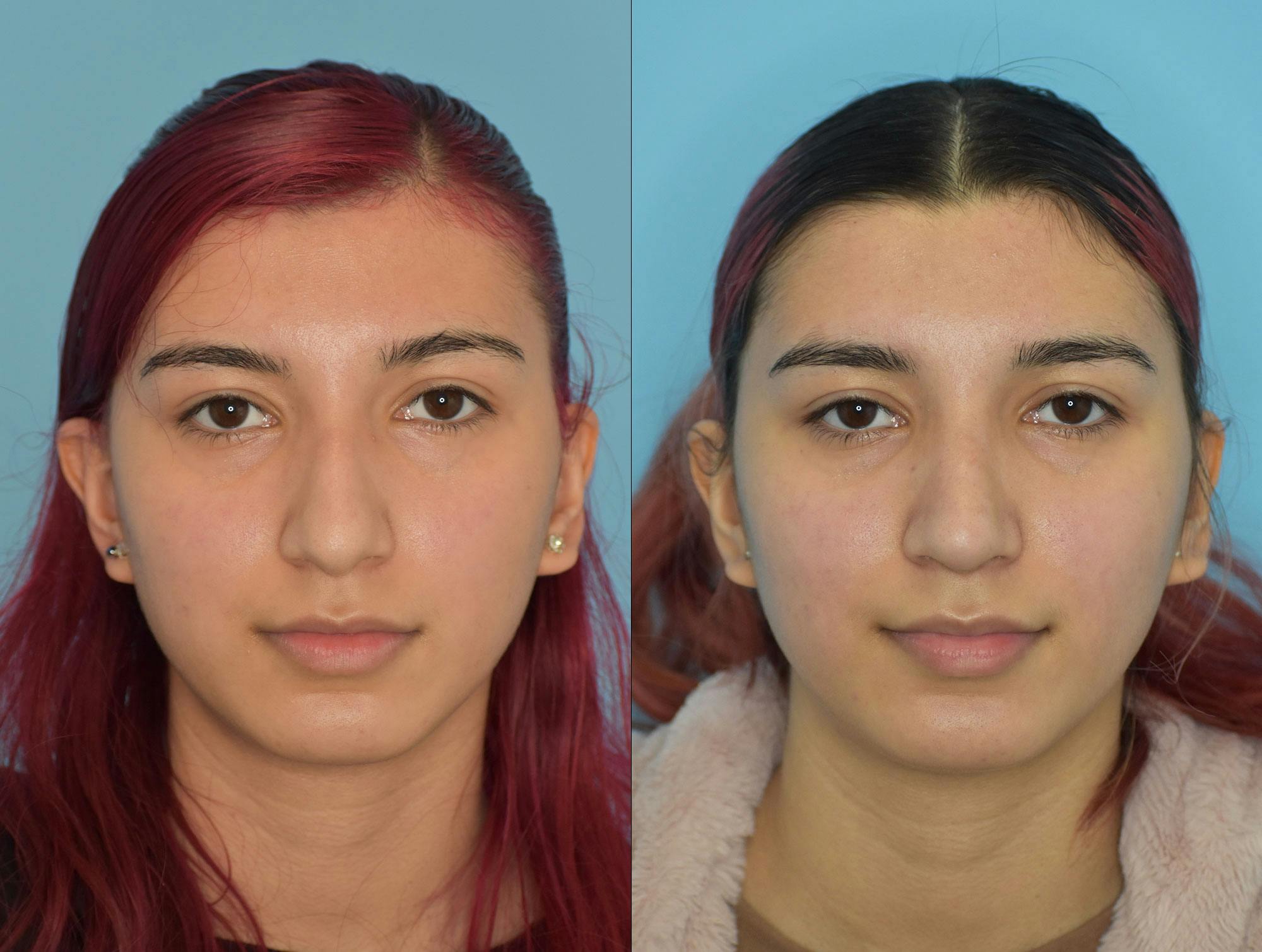 Rhinoplasty Before & After Gallery - Patient 180383014 - Image 3