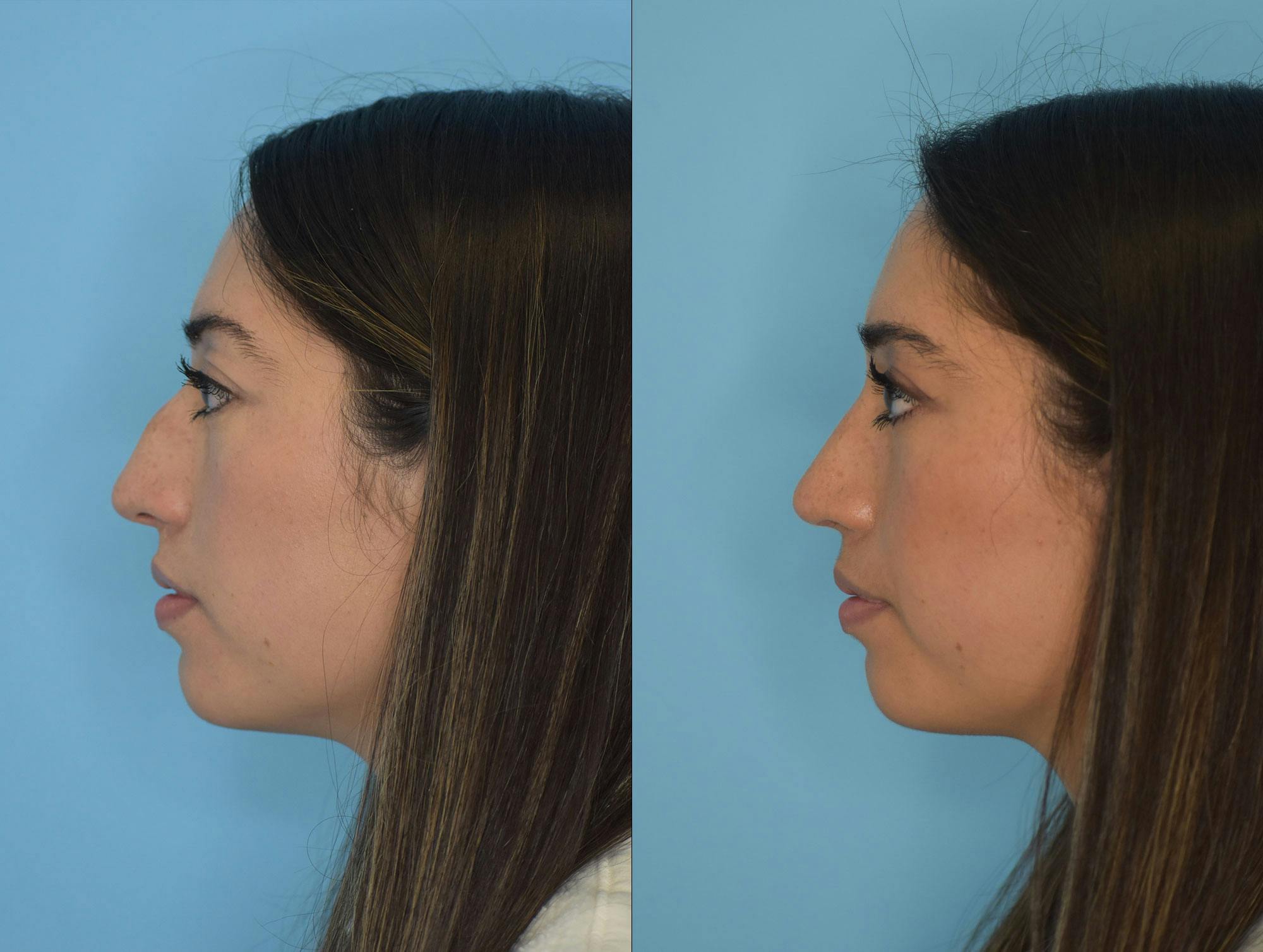 Rhinoplasty Before & After Gallery - Patient 180382924 - Image 1