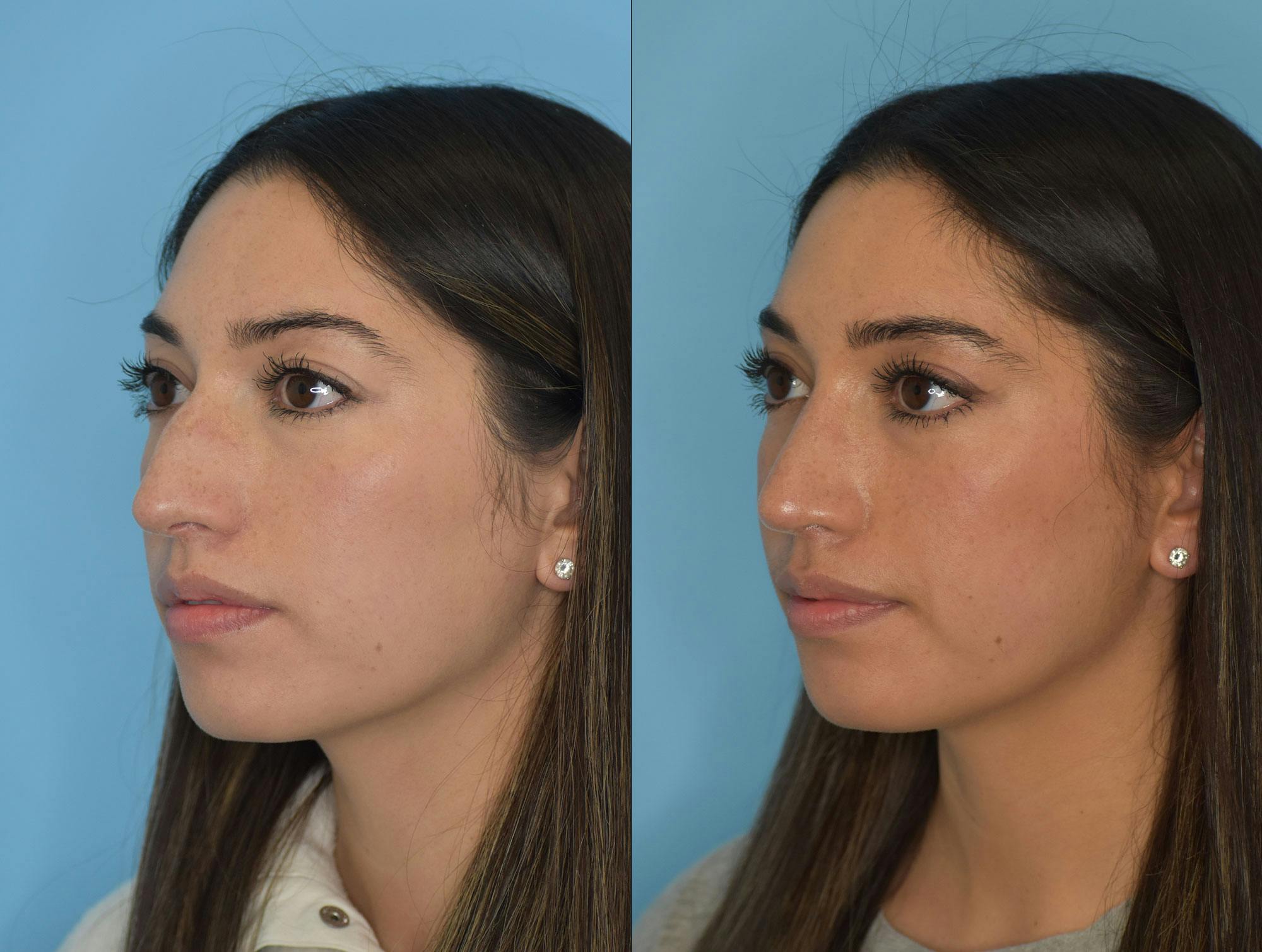 Rhinoplasty Before & After Gallery - Patient 180382924 - Image 2