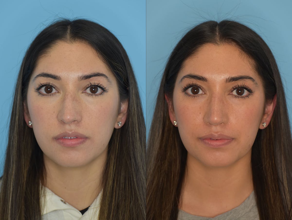 Rhinoplasty Before & After Gallery - Patient 180382924 - Image 3