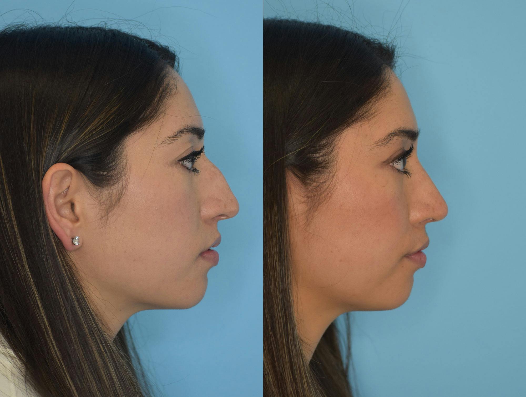 Rhinoplasty Before & After Gallery - Patient 180382924 - Image 4