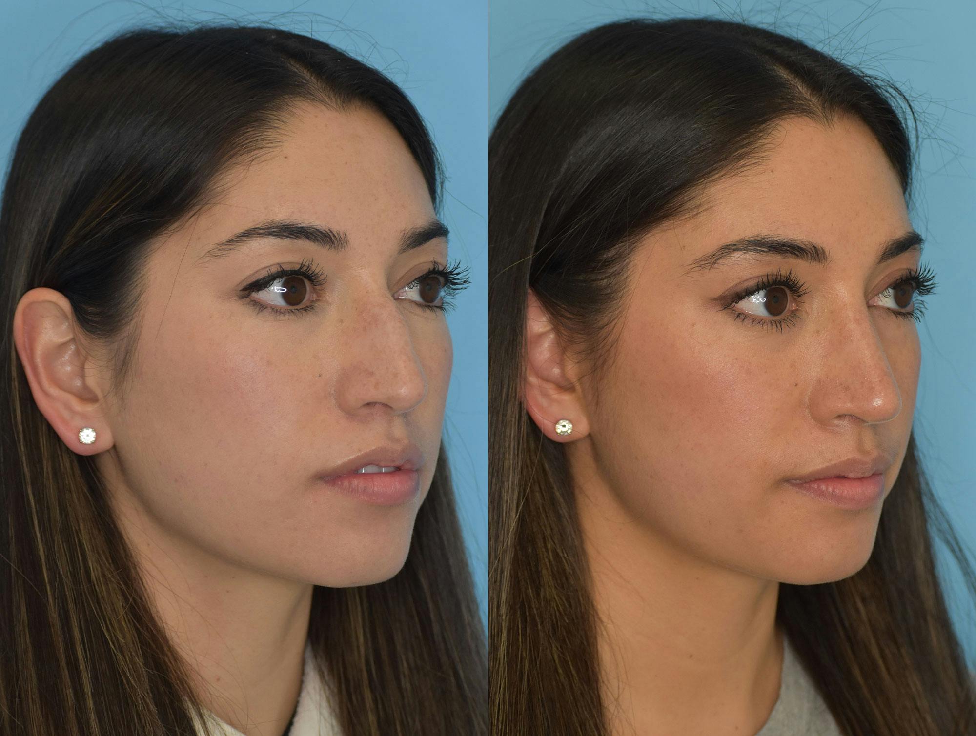Rhinoplasty Before & After Gallery - Patient 180382924 - Image 5