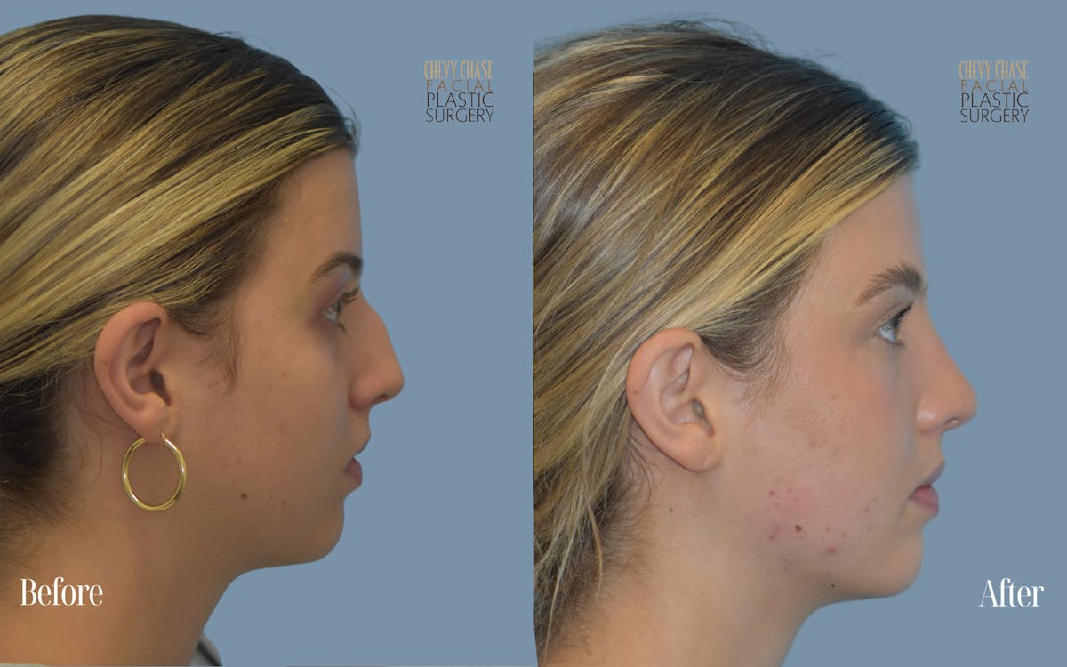 Rhinoplasty Before & After Gallery - Patient 272817 - Image 2