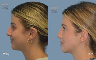 Rhinoplasty Before & After Gallery - Patient 272817 - Image 1