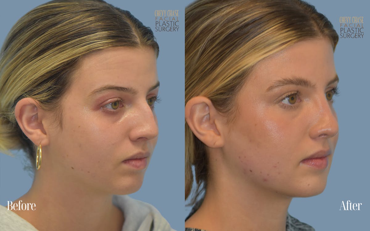 Rhinoplasty Before & After Gallery - Patient 272817 - Image 5