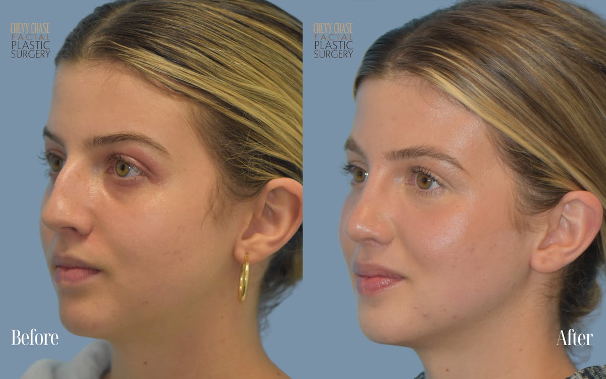 Rhinoplasty Before & After Gallery - Patient 272817 - Image 4