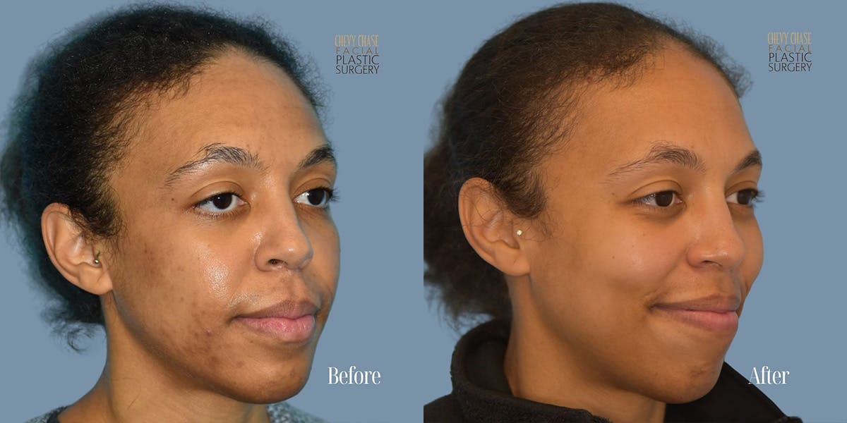 Aerolase Neo® Before & After Gallery - Patient 123496 - Image 2
