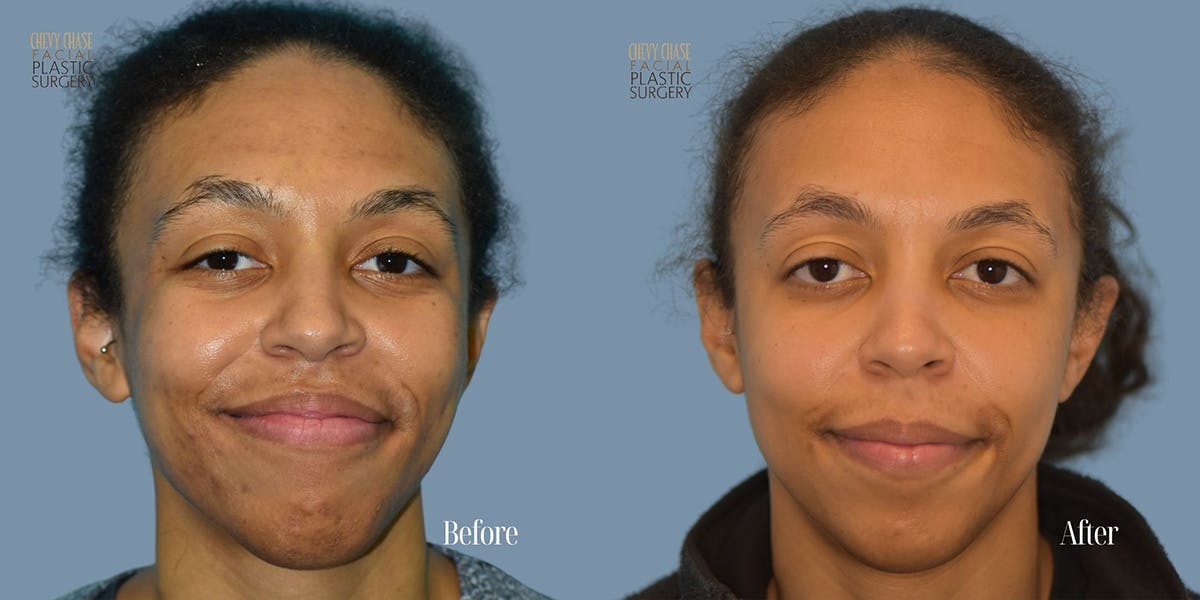 Aerolase Neo® Before & After Gallery - Patient 123496 - Image 1