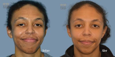 Aerolase Neo® Before & After Gallery - Patient 123496 - Image 1