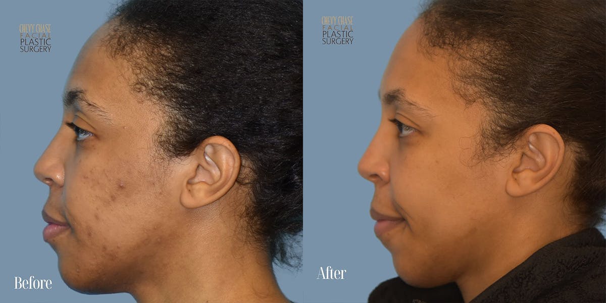 Aerolase Neo® Before & After Gallery - Patient 123496 - Image 3