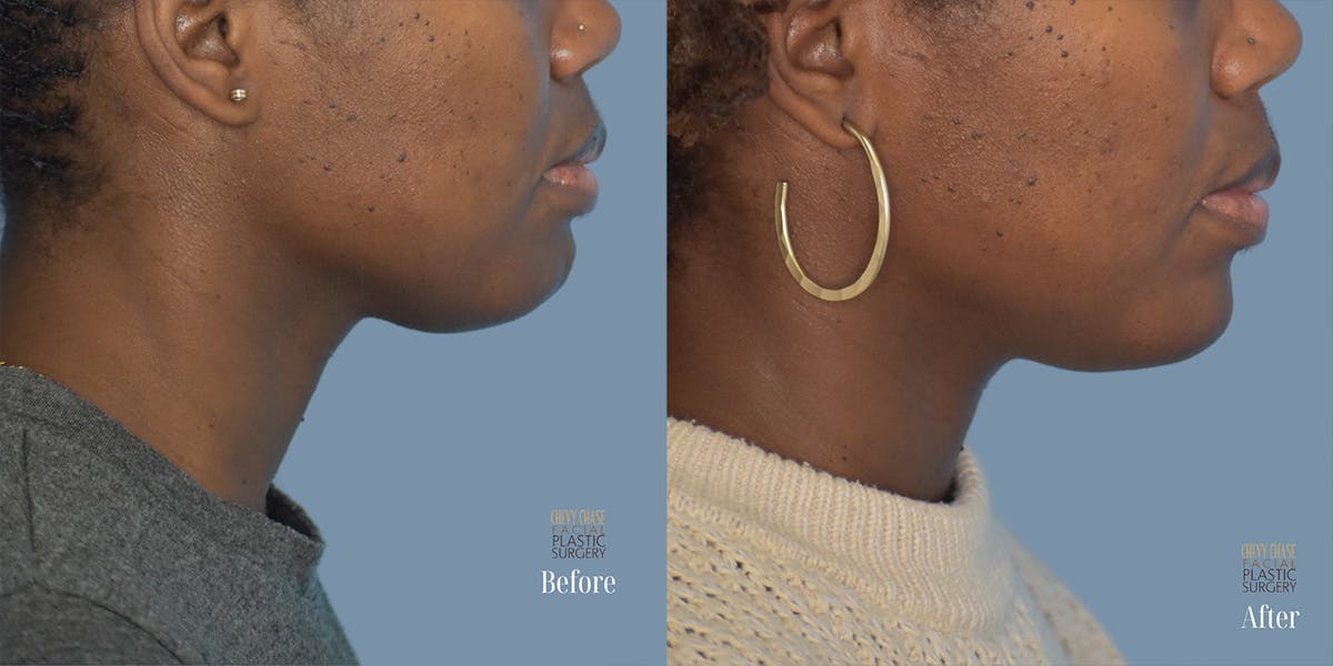 Dermal Fillers Before & After Gallery - Patient 201488 - Image 2