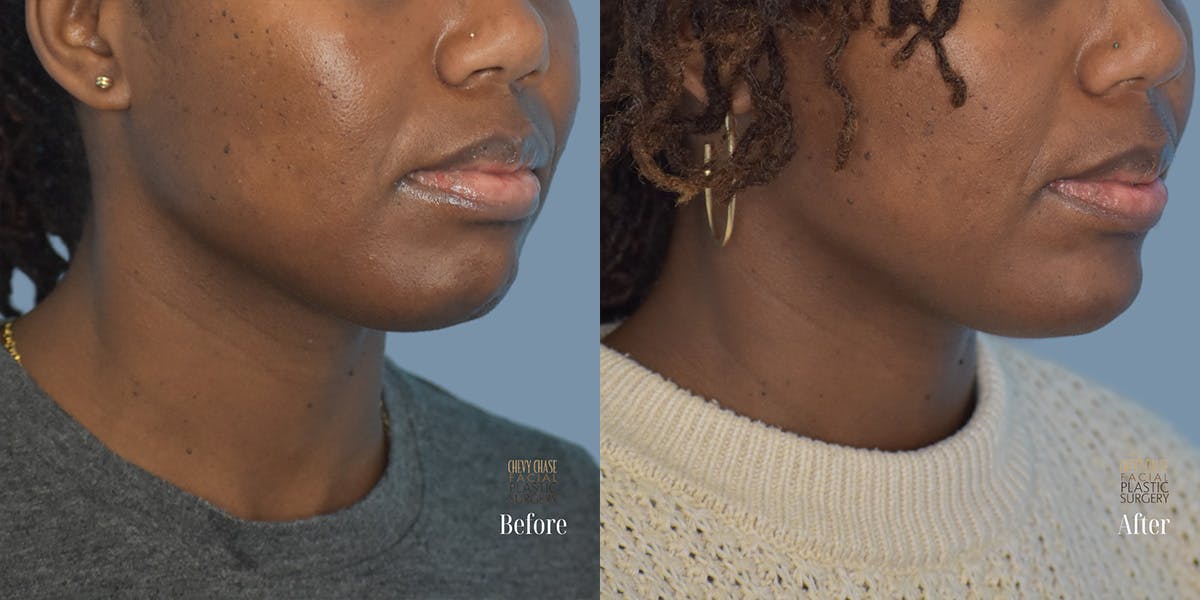 Dermal Fillers Before & After Gallery - Patient 201488 - Image 1
