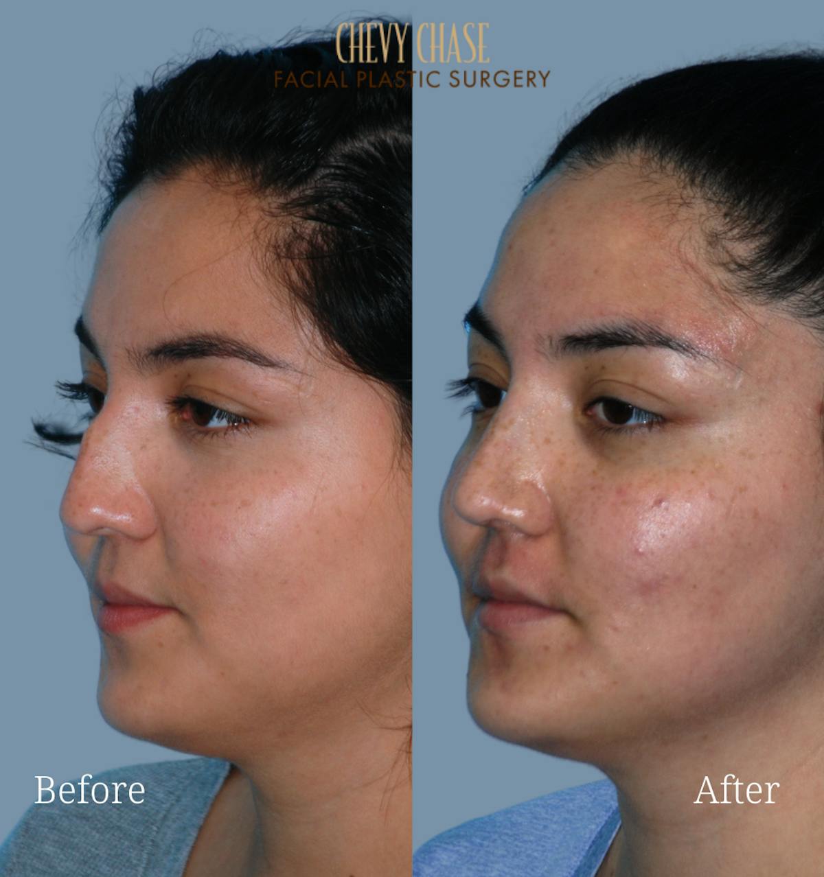 Rhinoplasty Before & After Gallery - Patient 223982 - Image 2