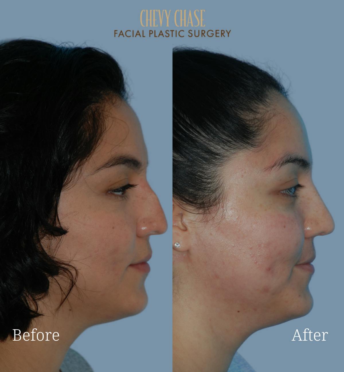 Rhinoplasty Before & After Gallery - Patient 223982 - Image 3