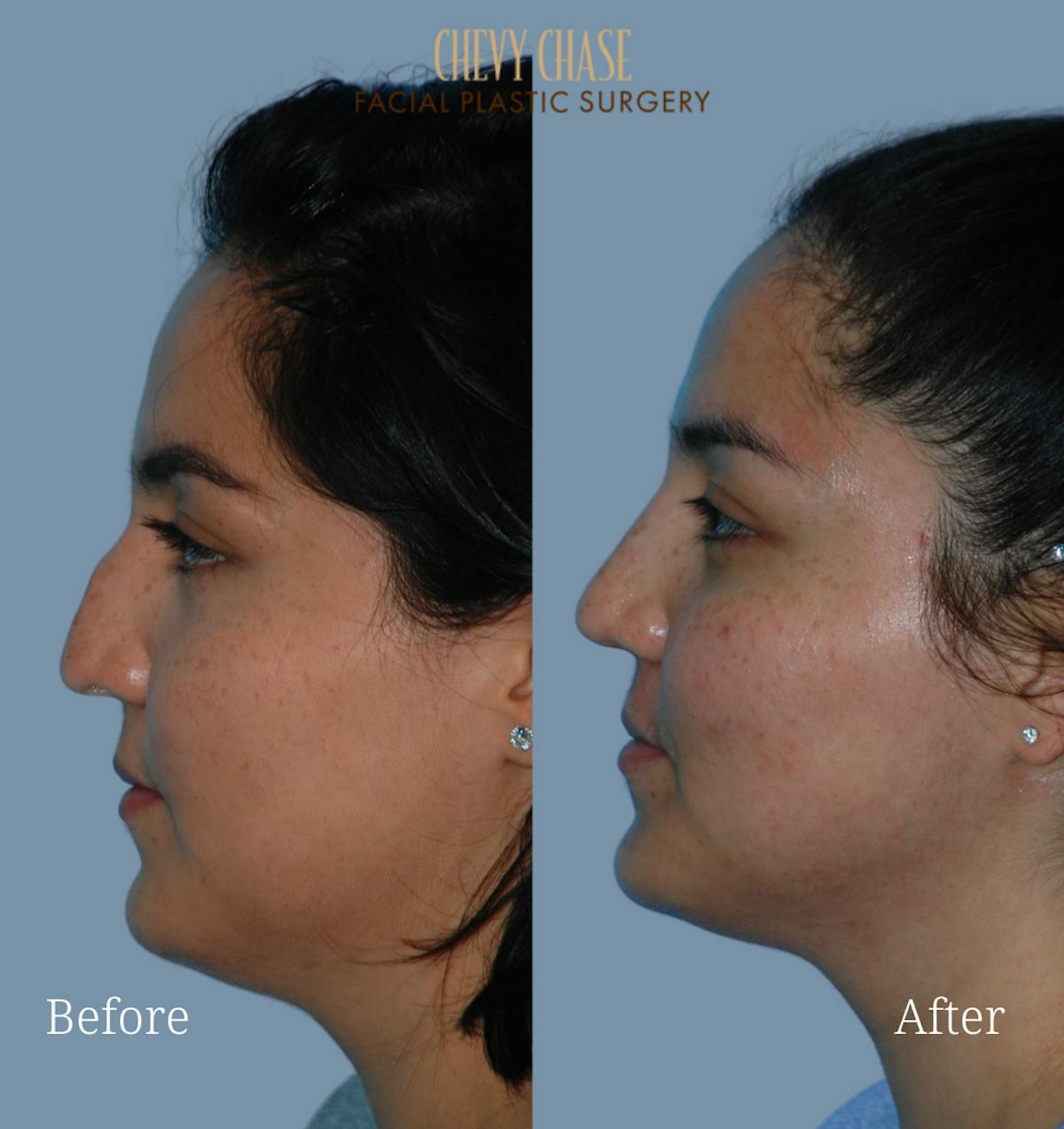 Rhinoplasty Before & After Gallery - Patient 223982 - Image 1