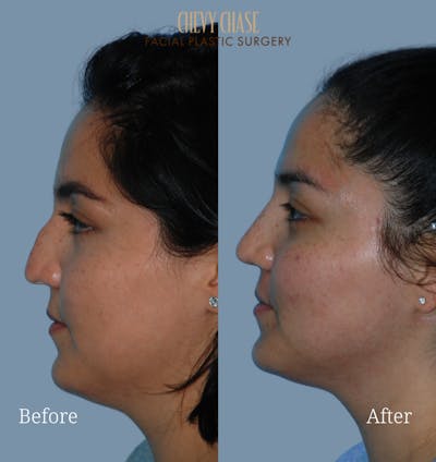 Rhinoplasty Before & After Gallery - Patient 223982 - Image 1