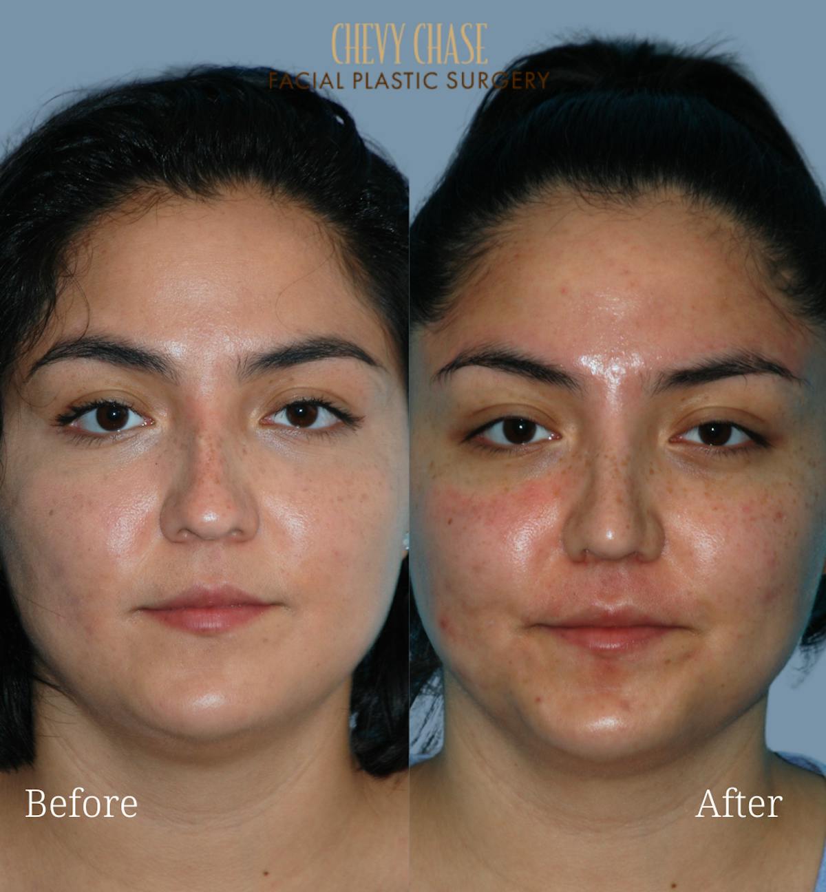 Rhinoplasty Before & After Gallery - Patient 223982 - Image 4