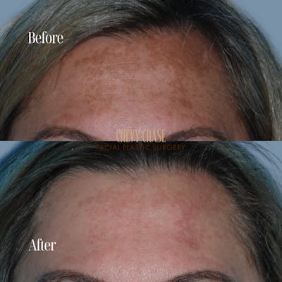 Broadband Light (BBL) Before & After Gallery - Patient 343189 - Image 1