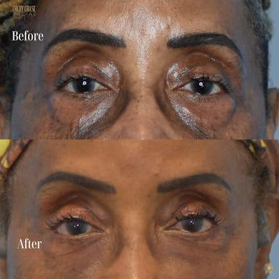Blepharoplasty Before & After Gallery - Patient 421430 - Image 1