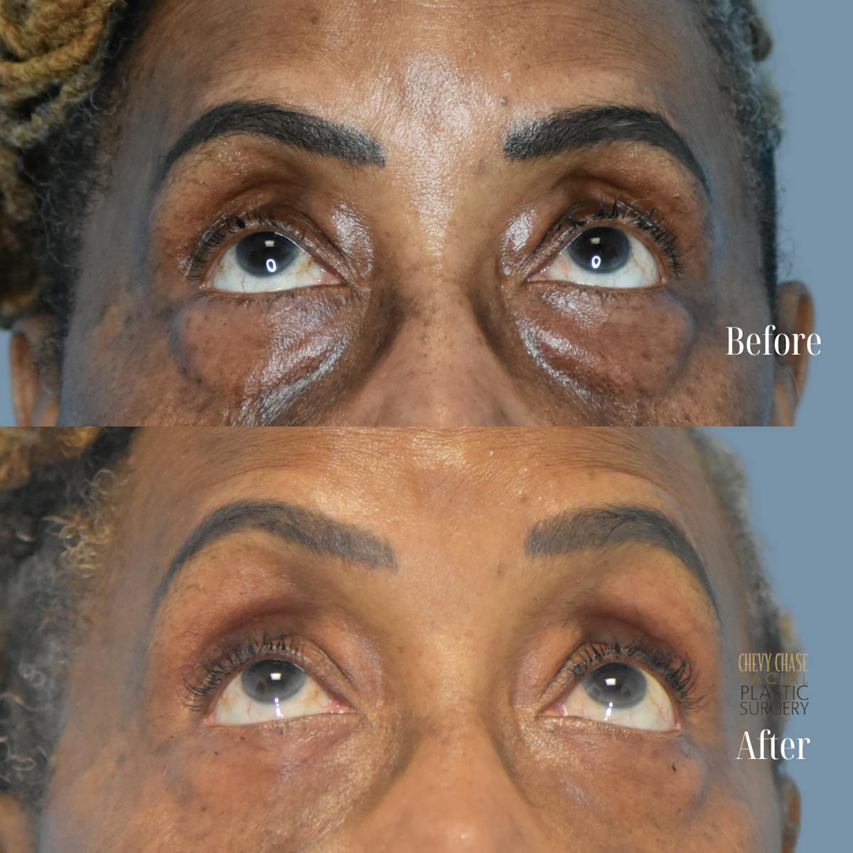 Blepharoplasty Before & After Gallery - Patient 421430 - Image 2