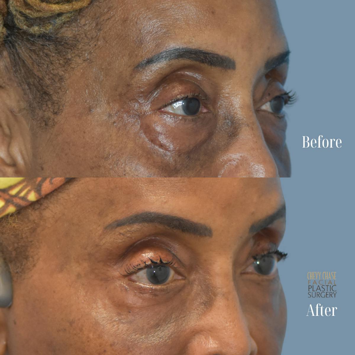 Blepharoplasty Before & After Gallery - Patient 421430 - Image 3