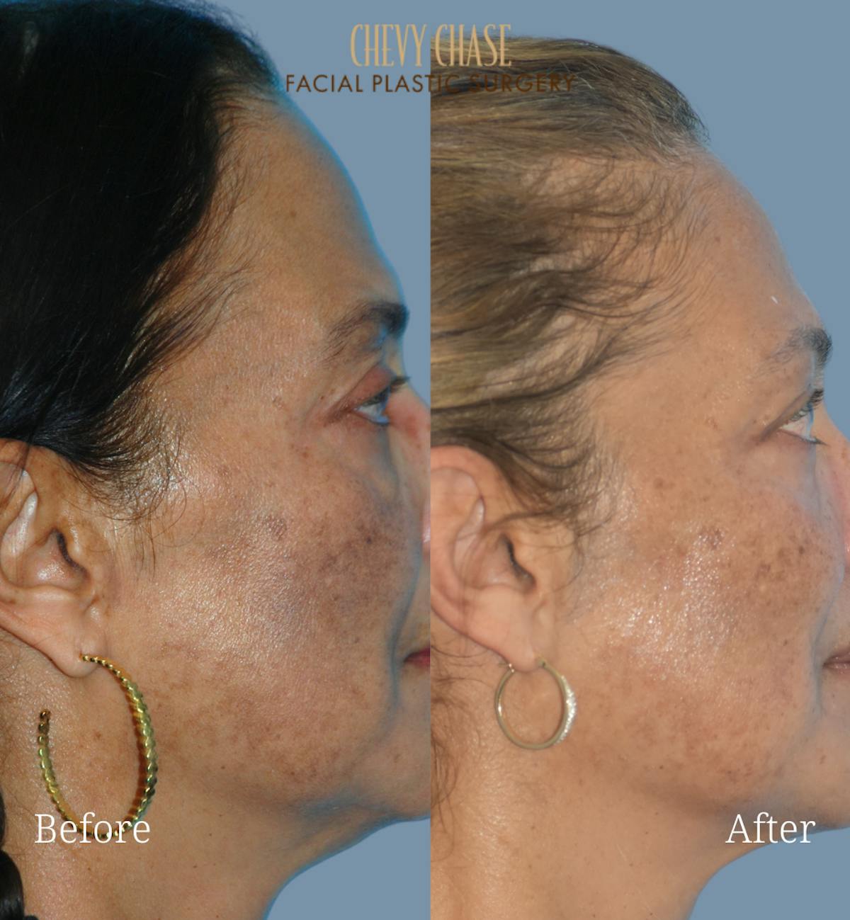 Aerolase Neo® Before & After Gallery - Patient 200814 - Image 2