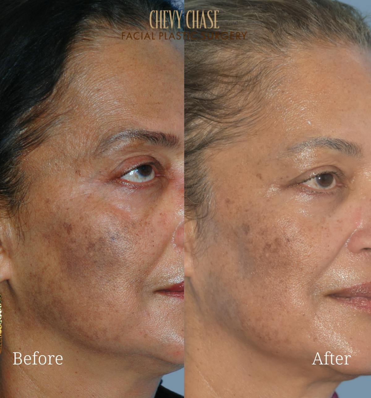 Aerolase Neo® Before & After Gallery - Patient 200814 - Image 1