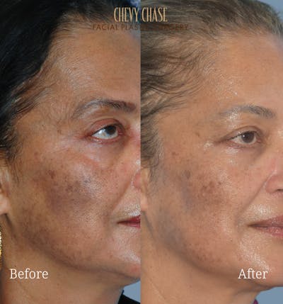 Aerolase Neo® Before & After Gallery - Patient 200814 - Image 1