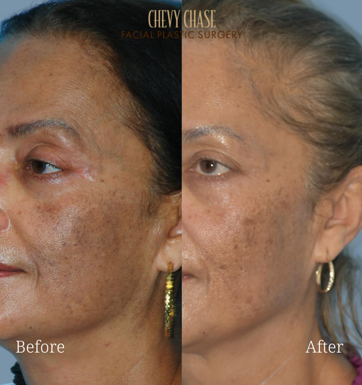 Aerolase Neo® Before & After Gallery - Patient 200814 - Image 3